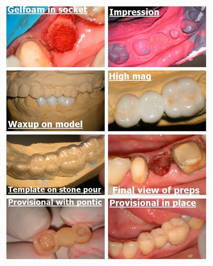 Resize of Bridge and laser for extraction final pg 3.jpg